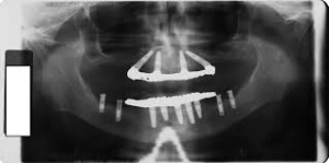 impianto procedura dentale all on four
